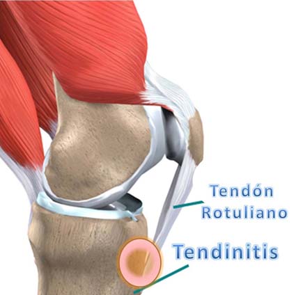 tenditis rotuliana